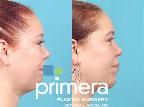 Submentoplasty (Chin Tuck) Before and After Pictures Case 870 | Orlando, Florida | Primera ...