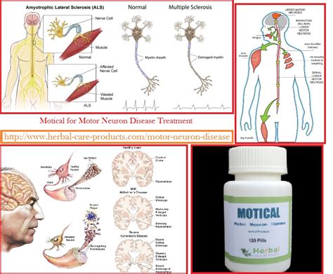 Herbal Care Products: Motor Neuron Disease Treatment by Herbal Products