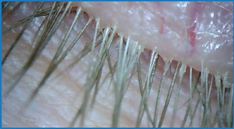 Demodex Blepharitis