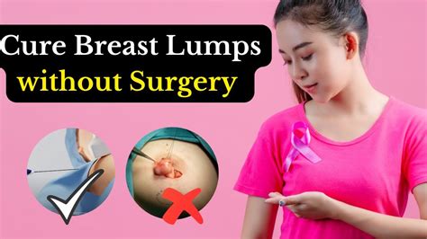 Cure Breast Lump Without Surgery | Breast Fibroadenoma | Non Surgical Treatment - YouTube