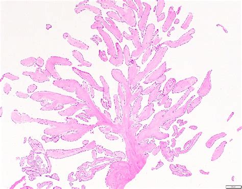 Pathology Outlines - Papillary fibroelastoma