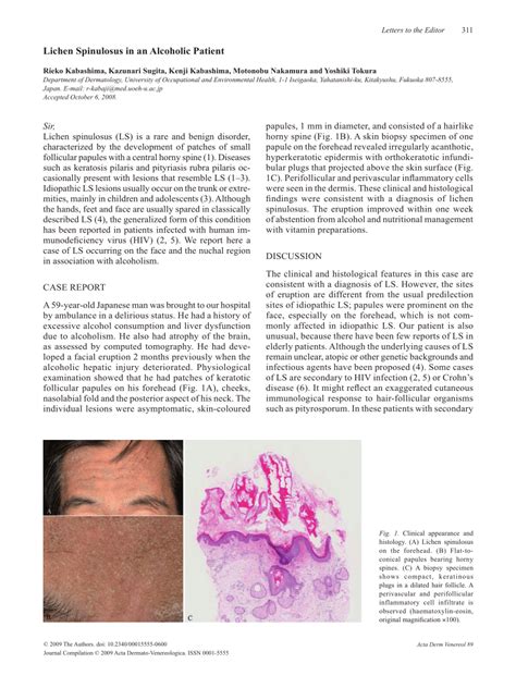 (PDF) Lichen Spinulosus in an Alcoholic Patient