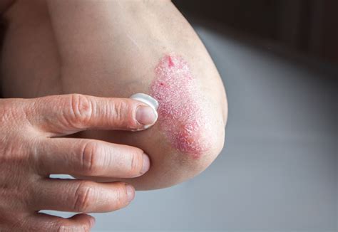 My skin itches. Is it psoriasis? What is that? - Veterans Health Administration