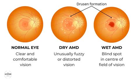 Age-Related Macular Degeneration: Causes, Symptoms and Treatment