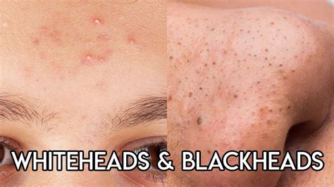 Whiteheads & Blackheads - YouTube