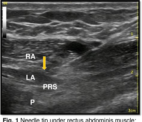 Figure 1 from ROLE OF ULTRASOUND GUIDED RECTUS SHEATH BLOCK AS A ...