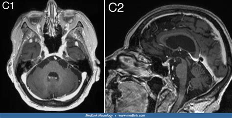 CLIPPERS | MedLink Neurology