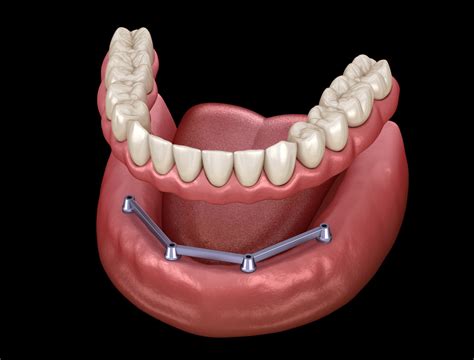 Removable Dentures - California Dental Care