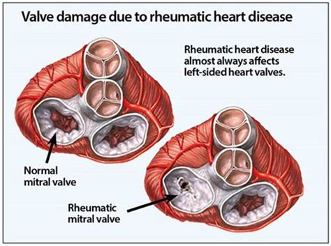 Pin on HEART VALVE LEAKAGE