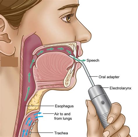 Total or partial laryngectomy procedure, complications, risks & recovery