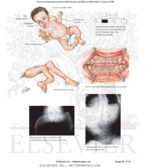 Osteogenesis Imperfecta Type 3