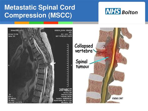 Spinal Cord Compression