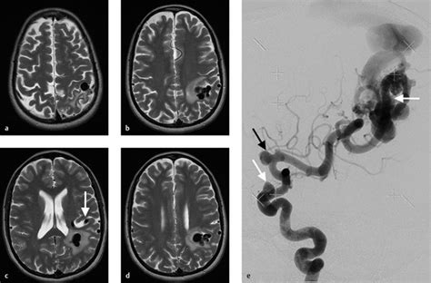 5 Cerebral Arteriovenous Malformations (AVMs) and Dural Arteriovenous Fistulas (dAVFs ...