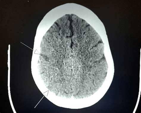 CT brain showing acute infarct in the right frontal and right parietal ...