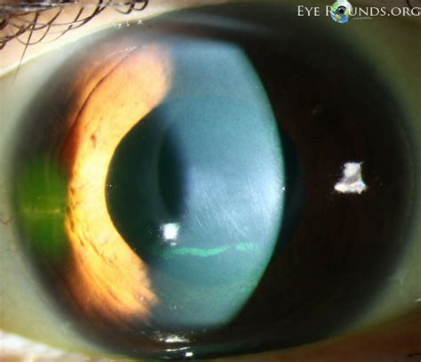 Atlas Entry - Vogt's striae in keratoconus