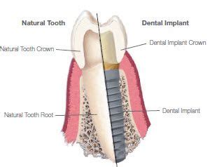 Biomet 3i Dental Implants – Find Local Dentist Near Your Area