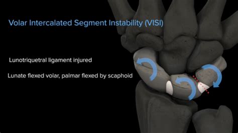 Lunotriquetral Ligament (LTL) Instability : OrthoPedia