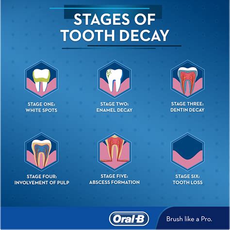 Stages of Tooth Decay - Oral-B