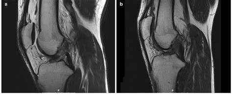 Torn Acl Mri Right Knee