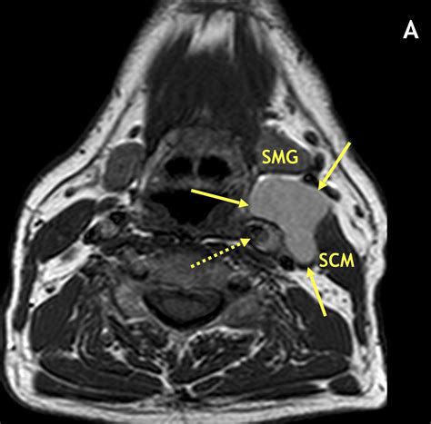 Branchial Cleft Cyst Diagram