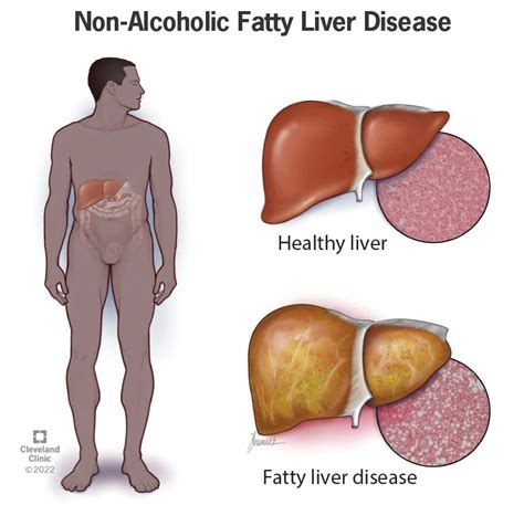 Early Signs of Non-Alcoholic Fatty Liver Disease - Fundahigado America