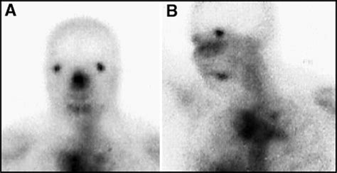 Diagnosis And Corresponding Gallium Scan