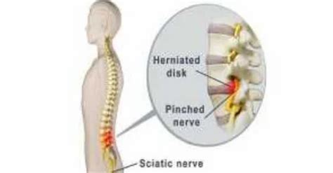 Sciatica Pinched Nerve Treatment at best price in New Delhi | ID: 19967673055