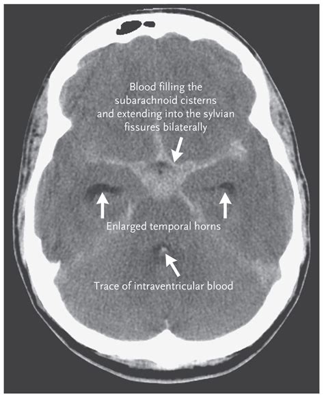 Subarachnoid Hemorrhage | NEJM