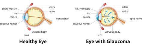 Glaucoma vs Cataracts