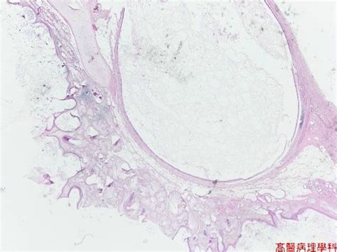 KMU Pathology Lab《Slide 38.》Dermoid cyst, Ovary