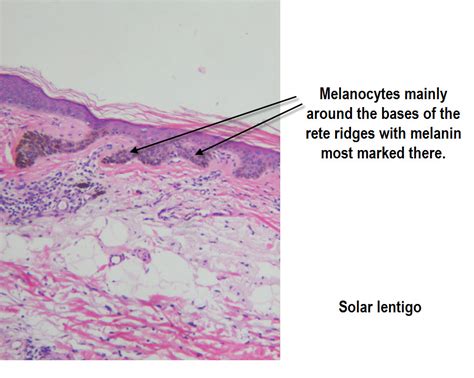 Dermpath Made Simple - Neoplastic: Benign Pigmented Lesions - Solar ...