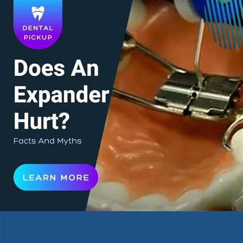 Does An Expander Hurt? Facts And Myths - Dental Pickup