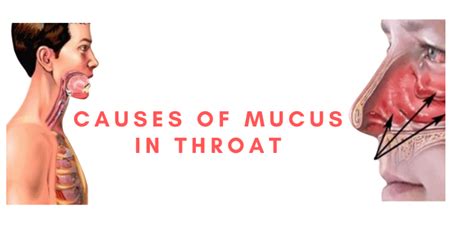 Causes of Mucus in Throat | Mucus in throat, Mucus, Phlegm in throat