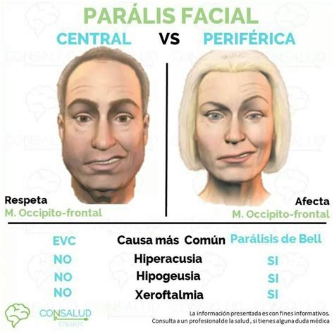 Terapia Fisica Paralisis Facial