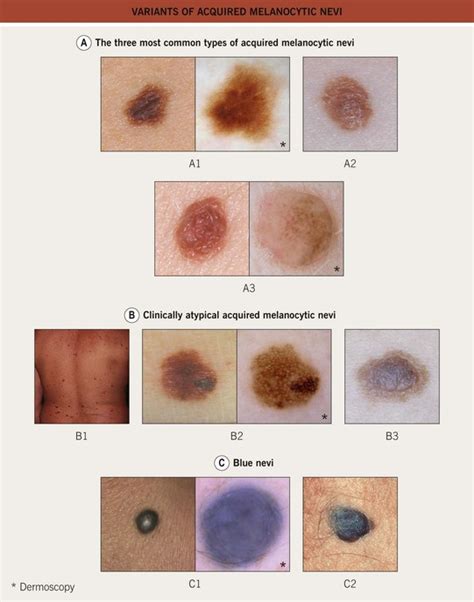 Benign Melanocytic Neoplasms | Plastic Surgery Key