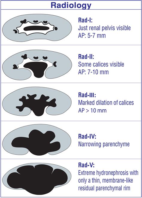 Radiology hydronephrosis grading system. | Download Scientific Diagram