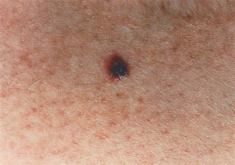 Melanoma pictures by stages, stage 0-1-2-3-4 melanoma pictures, melanoma in situ picture ...