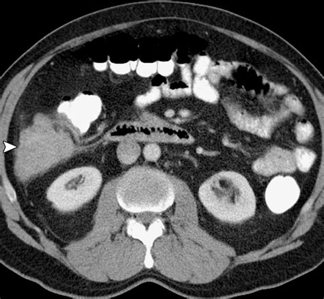 Imaging of Uncommon Retroperitoneal Masses | RadioGraphics