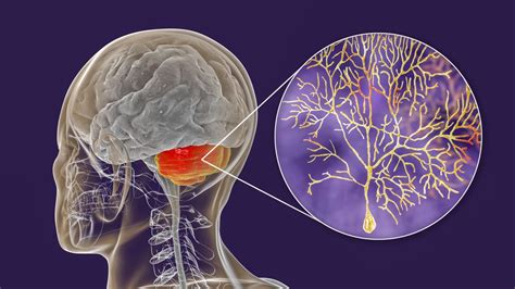 Ataxia - Acute Cerebellar : Overview, Causes, Symptoms, Treatment ...