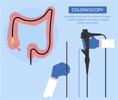 Colonoscopy in Hattiesburg, MS | Hattiesburg Clinic