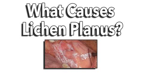 What is Oral Lichen Planus? • Nemeth & Katranji