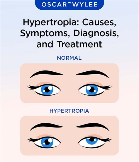 Hypertropia: Causes, Symptoms, Diagnosis, and Treatment