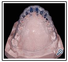 A New Procedure Reduces Laboratory Time to 6 Hours for the Elaboration of Immediate Loading ...