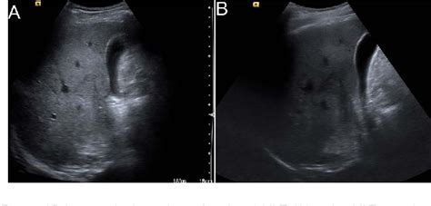 [PDF] Artifacts in diagnostic ultrasound | Semantic Scholar