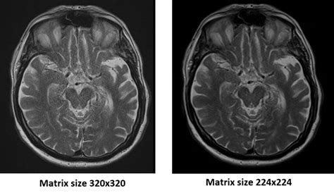 MRI Signal-to-noise ratio related artifact | SNR artifacts