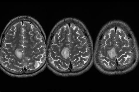 Dr Balaji Anvekar FRCR: Parietal lobe lesion on MRI