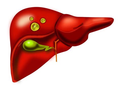 Liver Cysts: treatment for Liver Conditions | Liver Specialist Perth