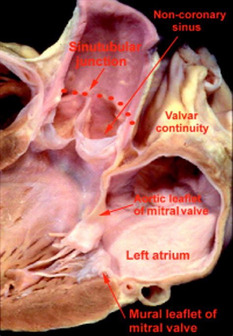 Clinical anatomy of the aortic root | Heart