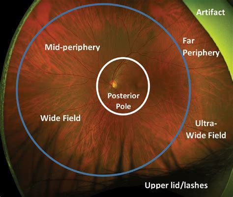 Ultra-Widefield Imaging: Expand Your Horizons