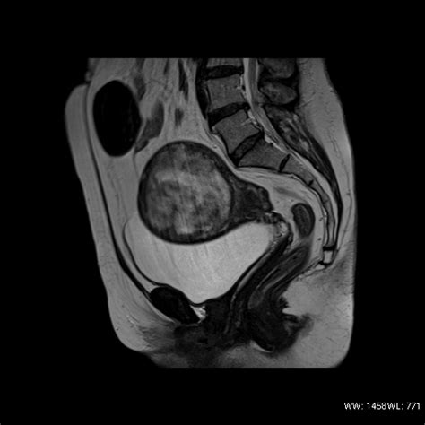 Fibroids Body Mri